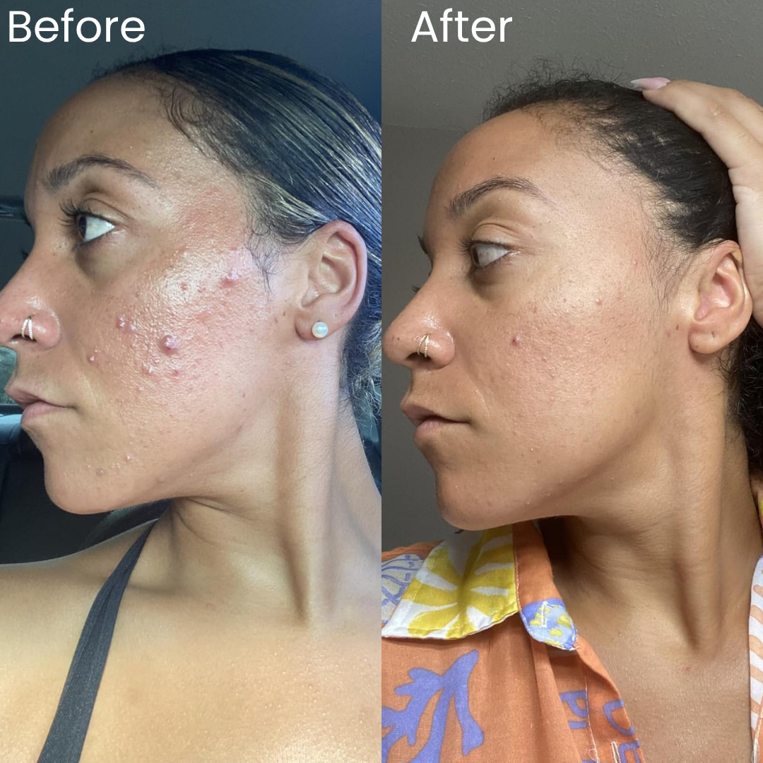 Turmeric & Kojic  Acid Soap