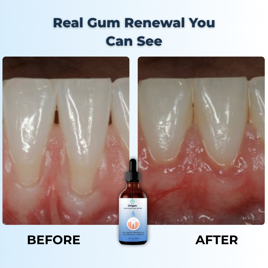 Origen - Fast Support for Receding Gums