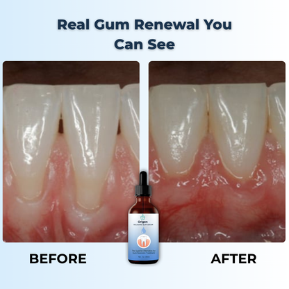 Origen - Fast Support for Receding Gums